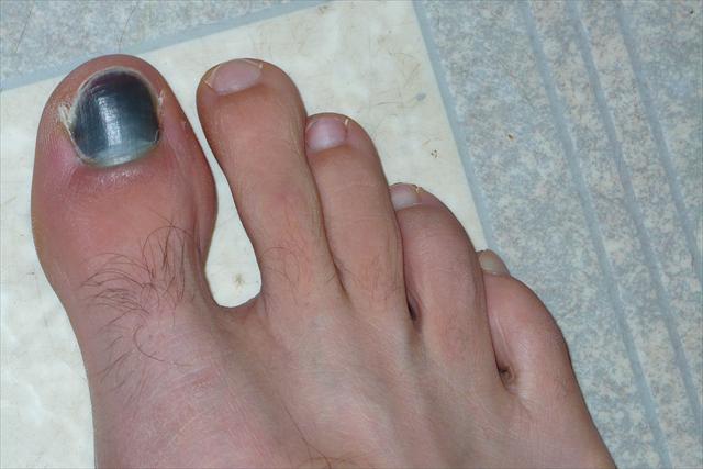 Subungual Melanoma: How to Spot Melanoma on Toenails ...
