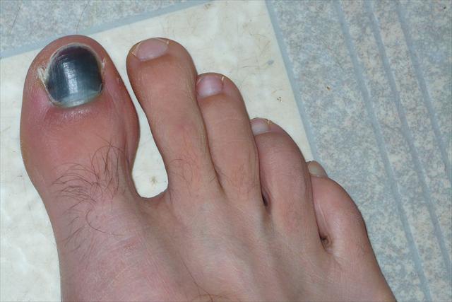 Subungual Melanoma: How to Spot Melanoma on Toenails ...