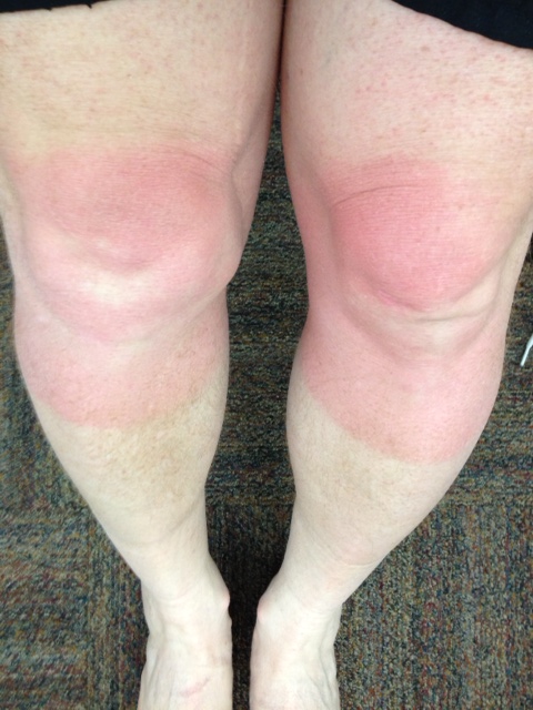 burntknee1.jpg